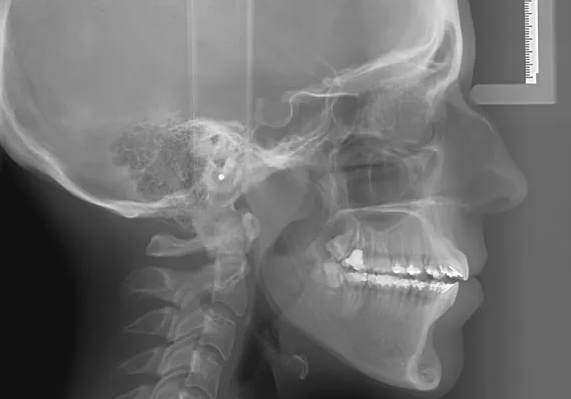 Telerradiografía cefalométrica lateral